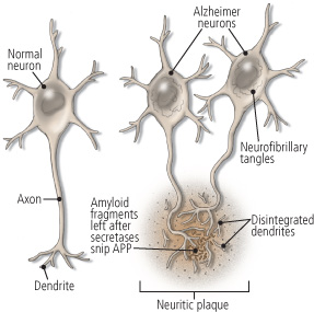 Ricerca anticonvenzionale conclude che proteine anti-infiammatorie possono provocare le placche dell'Alzheimer