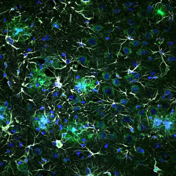 Possono essere gli astrociti, quando alterati, a portare alle neurodegenerazioni?