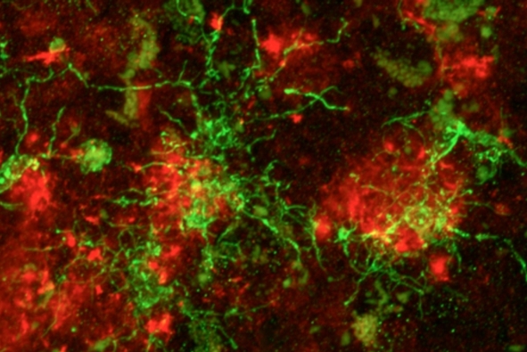 Bocco di recettore delle cellule immunitarie inverte l'Alzheimer ... nei topi