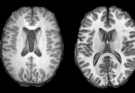 Trauma cranico invecchia il cervello, e lo prepara alla demenza