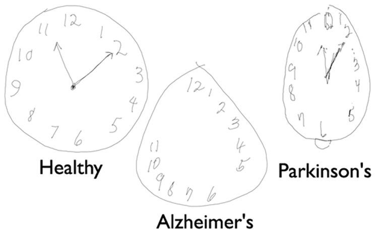 Alzheimer e Parkinson sono stimolati dallo stesso enzima