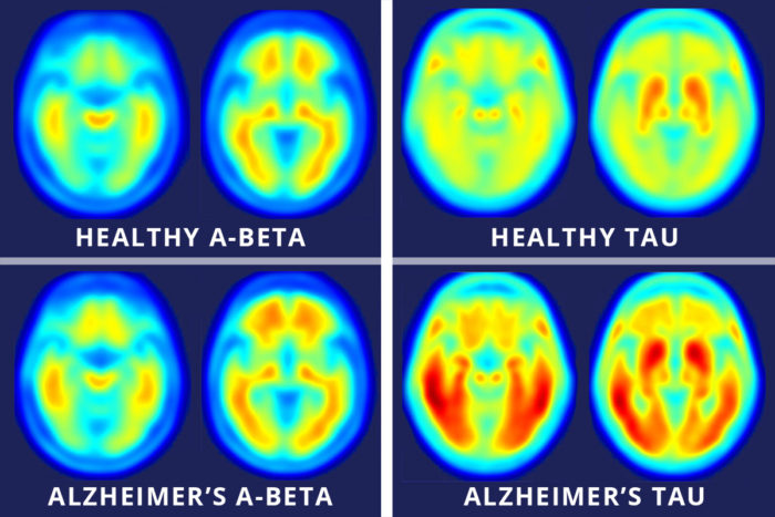 Le scansioni della TAU rappresentano meglio dell'amiloide il decorso dell'Alzheimer