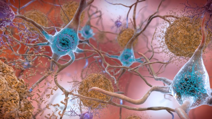 neurons with amyloid and tau