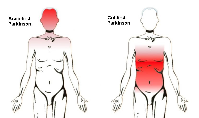 parkinson from brain or gut