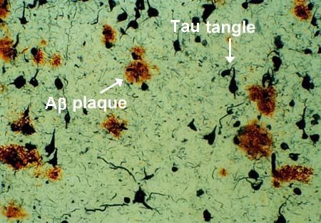 Amiloide e tau presenti precocemente e insieme nella stessa area del cervello