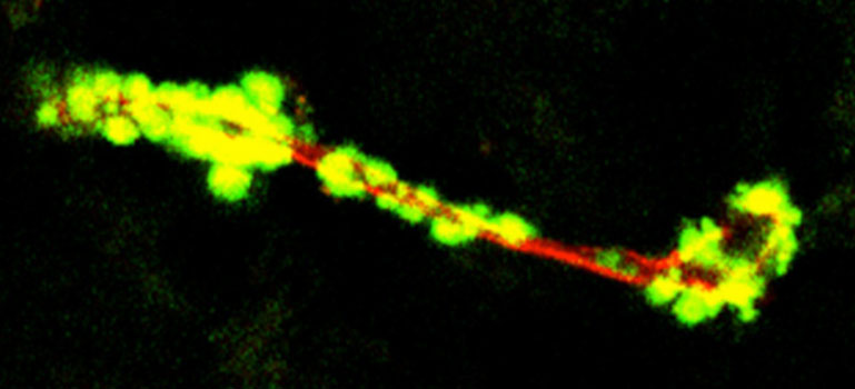 La struttura dell'amiloide nei vasi capillari è l'ultimo indizio dell'Alzheimer?