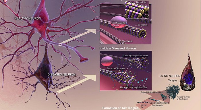 Come si accumulano i grovigli nel cervello, innescando le neurodegenerazioni
