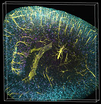Nuova tecnica di scansione 3D mostra schemi inaspettati di placche di amiloide