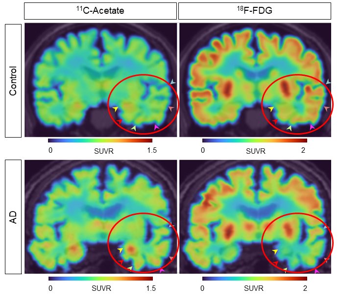 11C acetate 18F FDG in control and AD patients