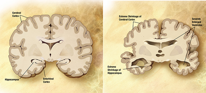 Un team è riuscito a sopprimere lo stress ossidativo e la morte dei neuroni associati all'Alzheimer