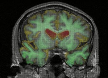 L'amiloide-beta provoca perdita di memoria anche prima della degenerazione cerebrale