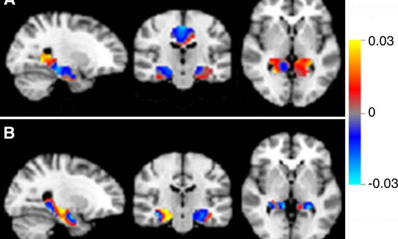 L'intelligenza artificiale può aiutare la diagnosi di Alzheimer