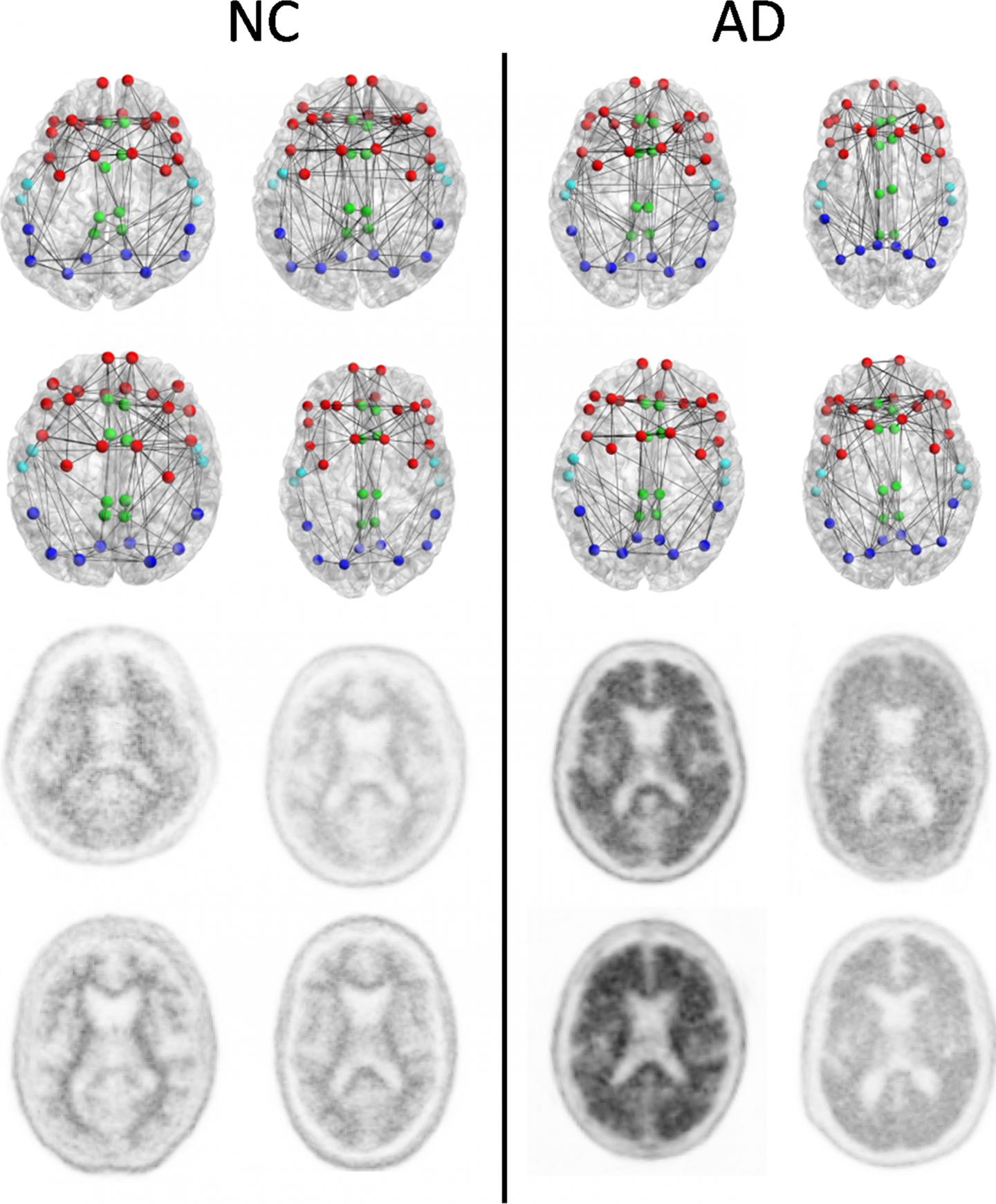 Connessioni nel cervello sono già rotte precocemente dall'Alzheimer