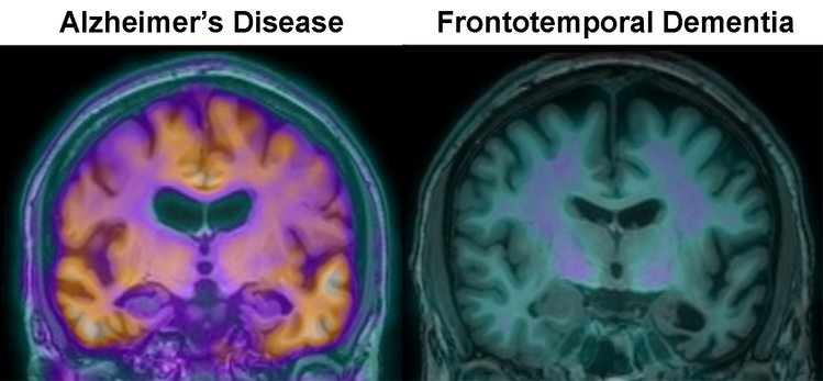 Scambiare la demenza frontotemporale con l'Alzheimer può ritardarne il trattamento