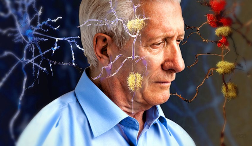Alzheimer Negative Outlook