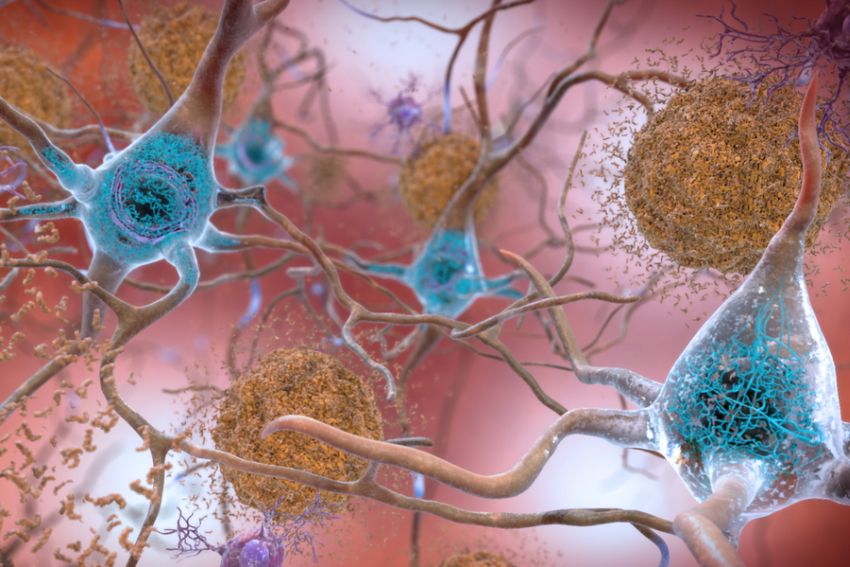 Alzheimers plaques tangles by NIA NIH