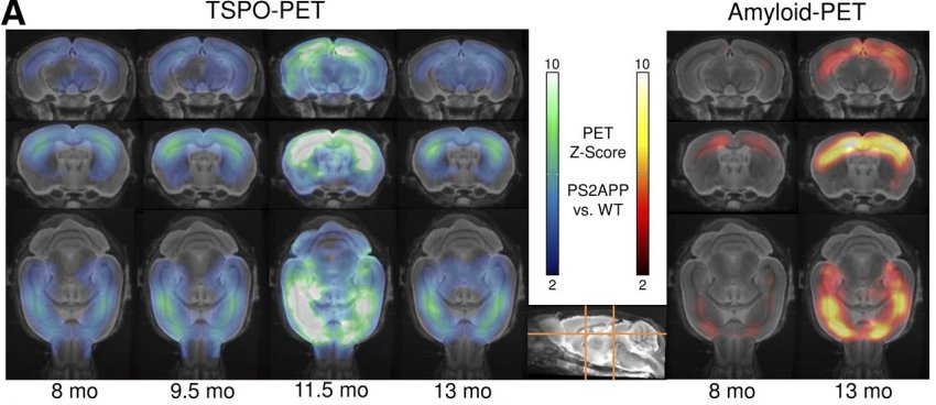 Alzheimers PET Focke Brendel