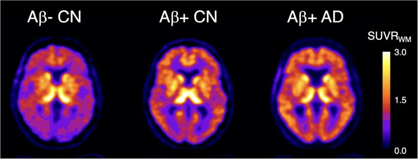 Amyloid beta in Alzheimer patient and control with new PET agent