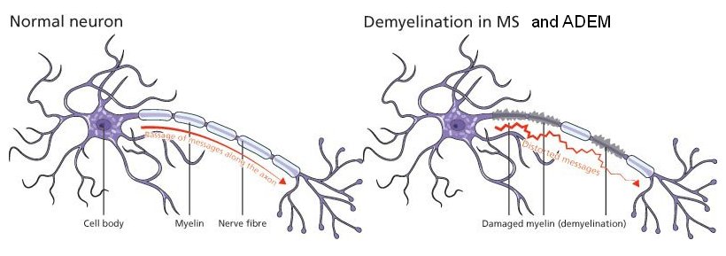 Axon demyelination