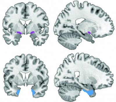 Studio contesta lo schema attuale di progressione dell'Alzheimer