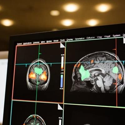 Il cervello combatte la demenza spostando le risorse
