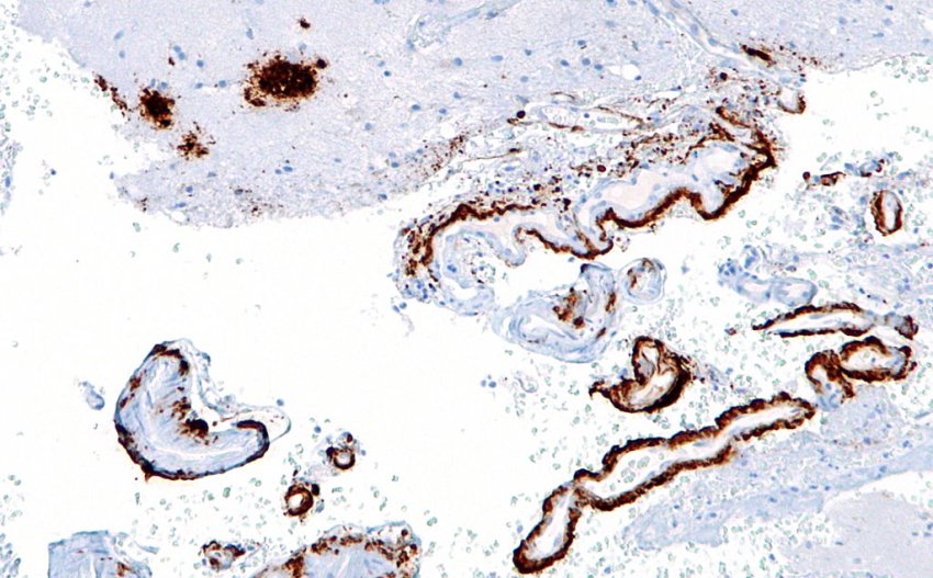 Cerebral amyloid beta