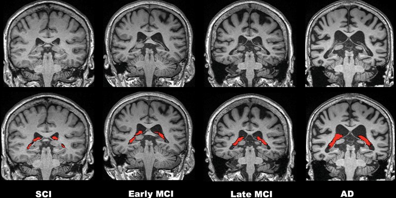 Choroid plexus comparison