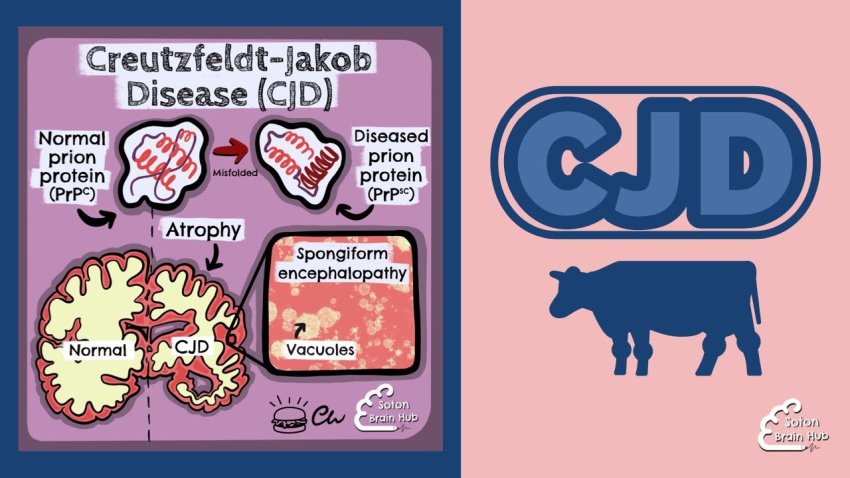 Creutzfeldt jakob disease
