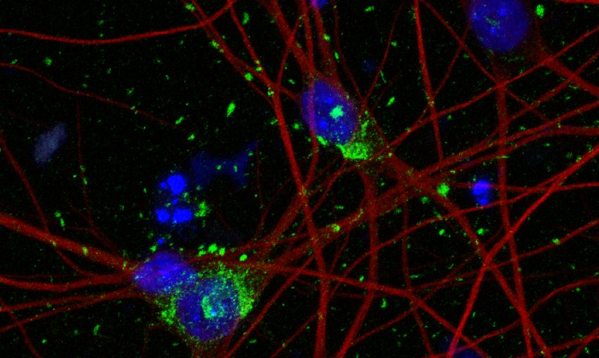 neurons cell nuclei blue neuron cytoskeleton red tau aggregates green