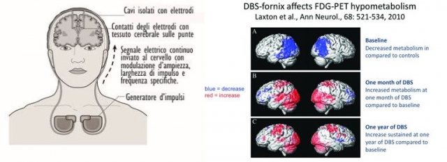 Deep brain stimulation scheme  outcome