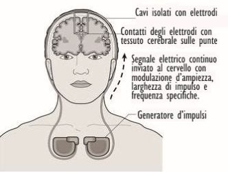 Deep brain stimulation scheme