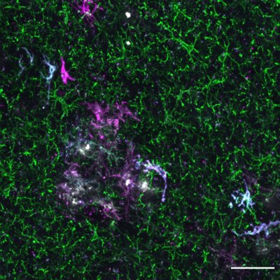 Different human microglia engrafted in mouse brain