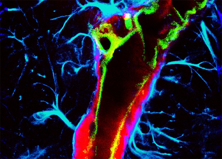 Enhanced glymphatic transport of intranasally delivered tracer red with ultrasound plus microbubbles 