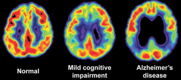 Ritardo nell'elaborazione delle parole può prevedere lo sviluppo dell'Alzheimer in seguito