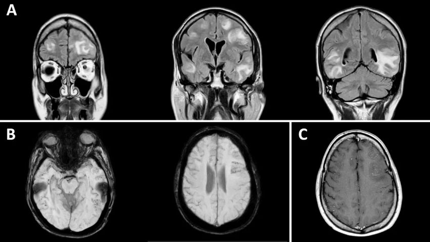 Gibbs MRI one week after onset of symptoms