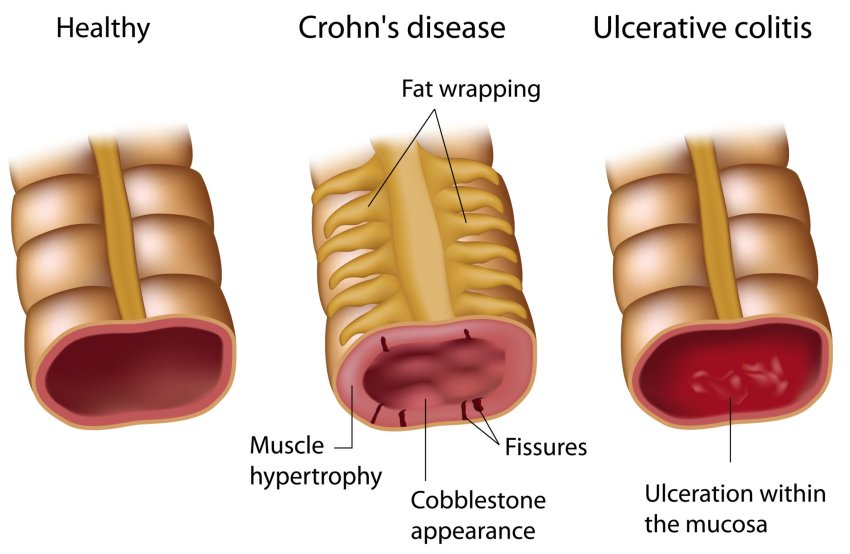 Healthy Intestine Colitis Crohn Disease