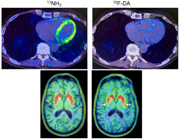 Heart and brain PET scans Goldstein et al