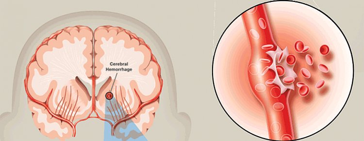 Il sanguinamento da ictus nel cervello associato all'insorgenza di demenza