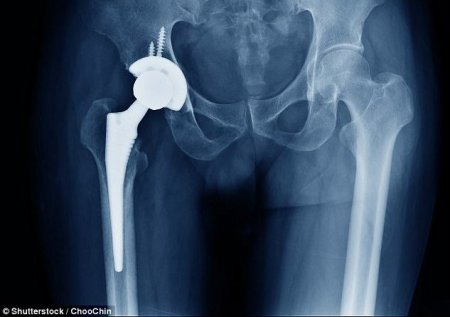 Protesi metalliche dell'anca: medici avvertono che potrebbe causare Alzheimer