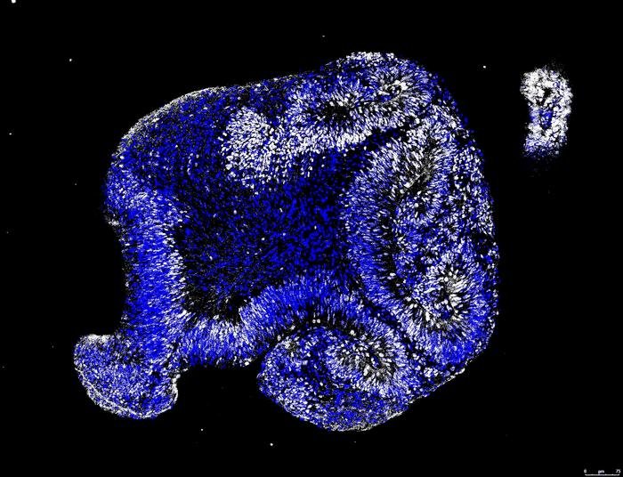 Human 3D cortical organoid with a PSEN1 mutation Erin Hurley University of Texas