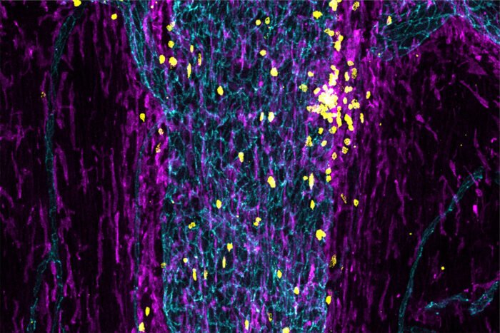 Immune cells yellow and purple fill a sinus teal in the outer layer of the meninges