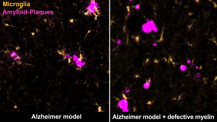 Immune cells in Alzheimer brain with degenerated myelin