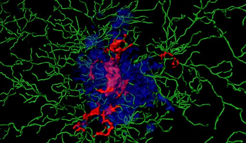 Inflammatory proteins red in a plaque blue plus immune cells green