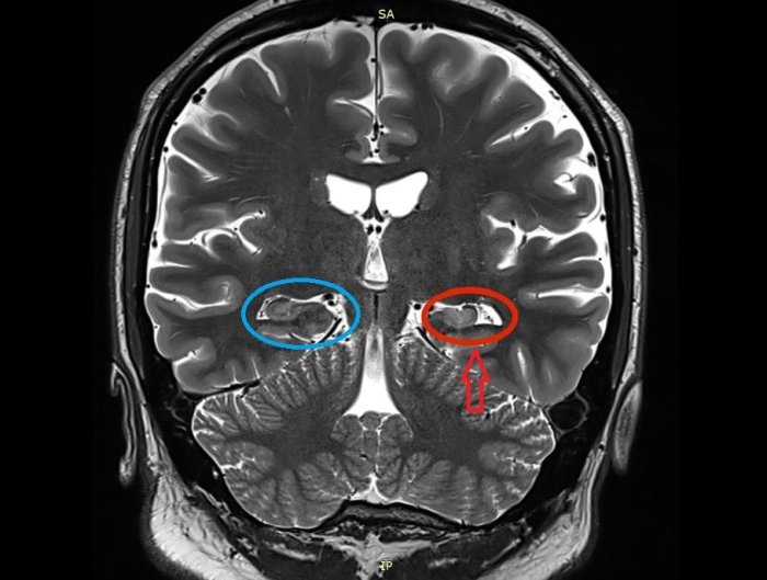 Left Hippocampal Sclerosis on MRI