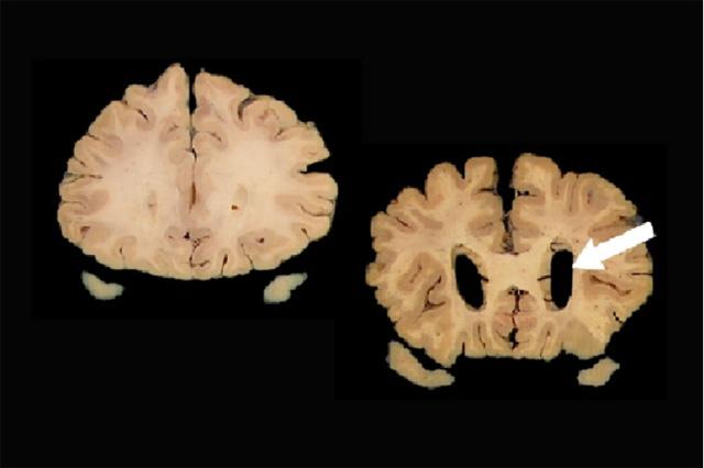 Left normal brain right dilation of ventricles arrow sign of atrophy