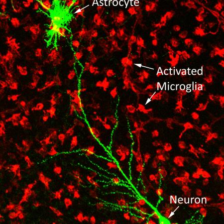 Microglia: il ruolo di queste cellule immunitarie sull'avanzamento dell'Alzheimer