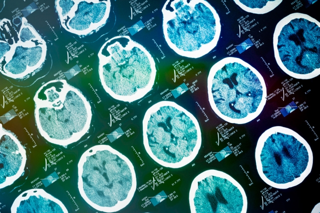 Sviluppato al MIT il sistema per predire i cambiamenti nel cervello di Alzheimer