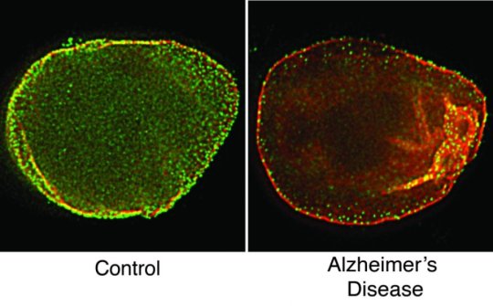 La struttura a maglia che circonda il nucleo dei neuroni è danneggiata nell'Alzheimer