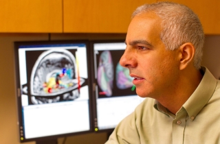 Trovate cellule infiammatorie contenenti ferro in cervelli di Alzheimer