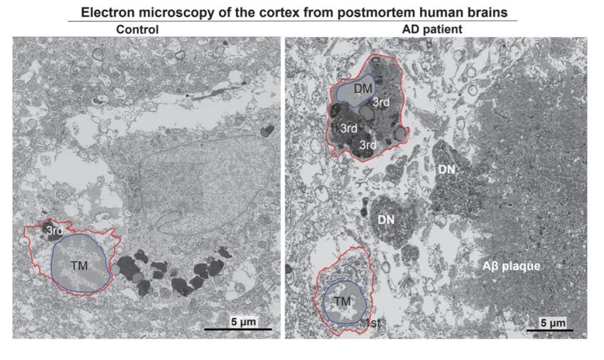 Microglia in prefrontal cortex of healthy lady left and dark microglia in patient with Alzheimer right Pinar 